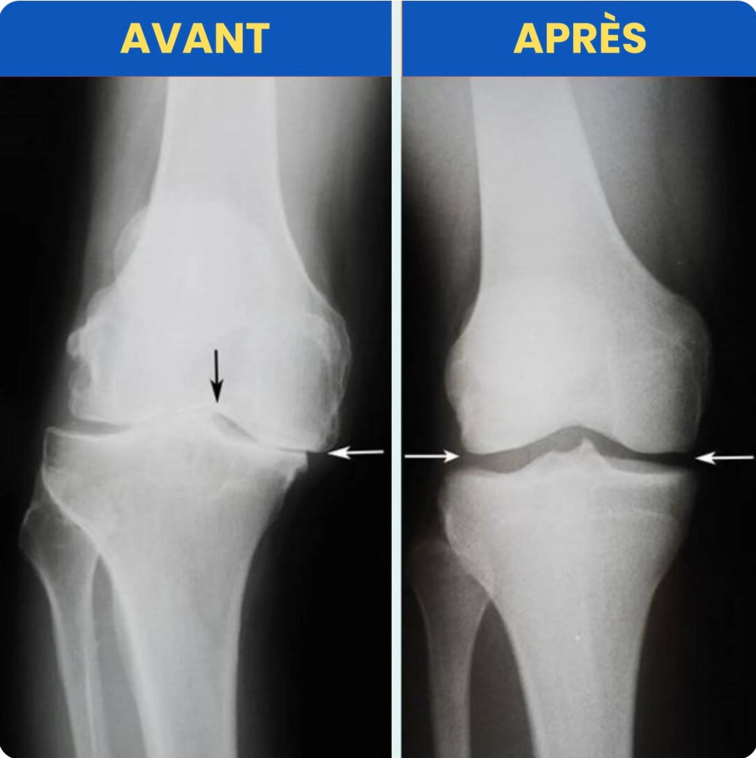 Genouillères Vilico™-Dites Adieu a vos douleurs aux Genoux